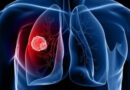 На Полтавщині захворюваність на всі форми туберкульозу зросла на понад 18%